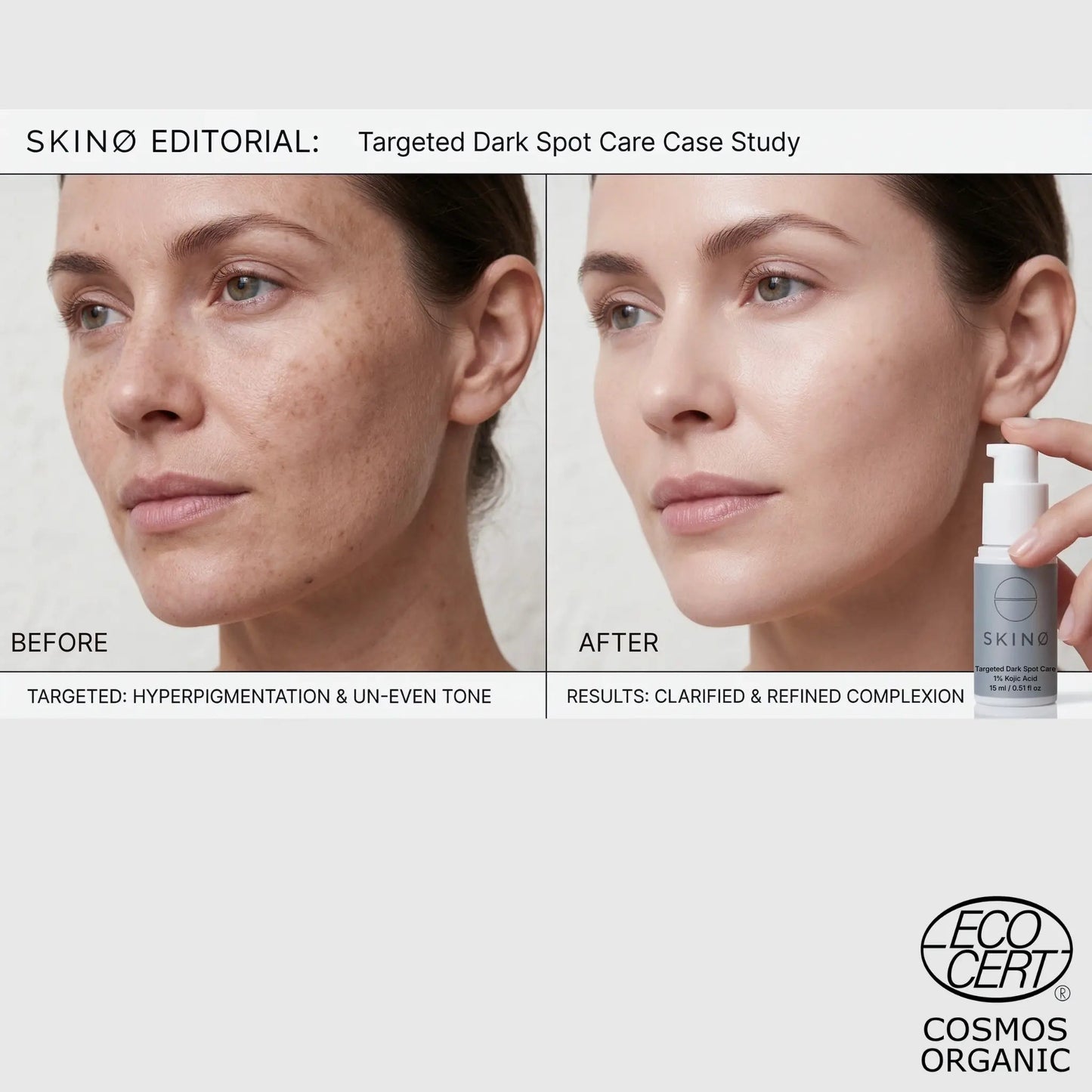 SKINØ Targeted Dark Spot Care resultat – before and after behandling mot hyperpigmentering och ojämn hudton, synligt klarare och jämnare hy med kojicsyra.