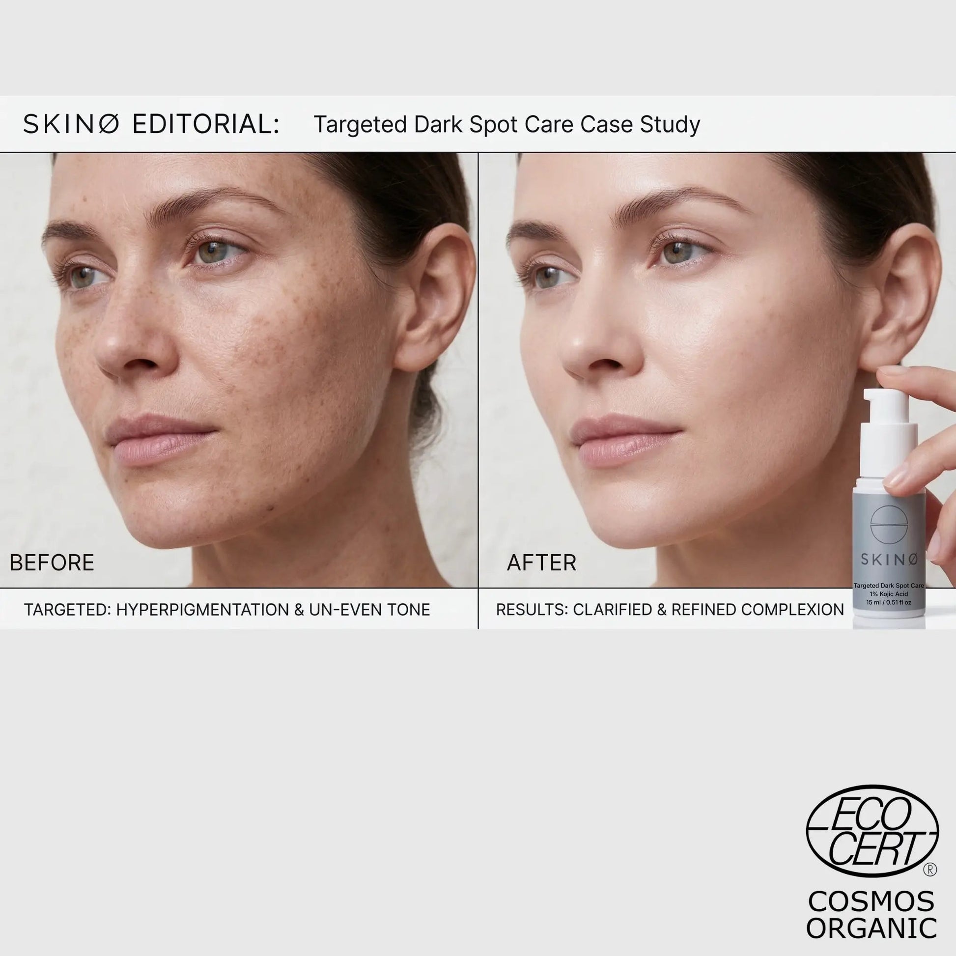 SKINØ Targeted Dark Spot Care resultat – before and after behandling mot hyperpigmentering och ojämn hudton, synligt klarare och jämnare hy med kojicsyra.