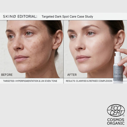SKINØ Targeted Dark Spot Care resultat – before and after behandling mot hyperpigmentering och ojämn hudton, synligt klarare och jämnare hy med kojicsyra.